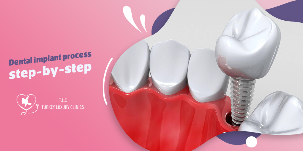 Exploring the dental implant process step-by-step: Your journey to a confident smile