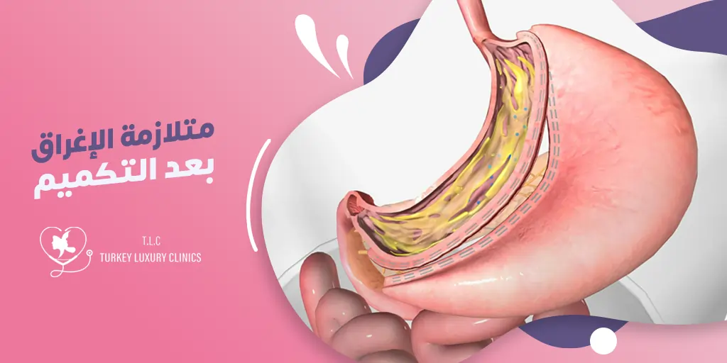 متلازمة الإغراق بعد التكميم