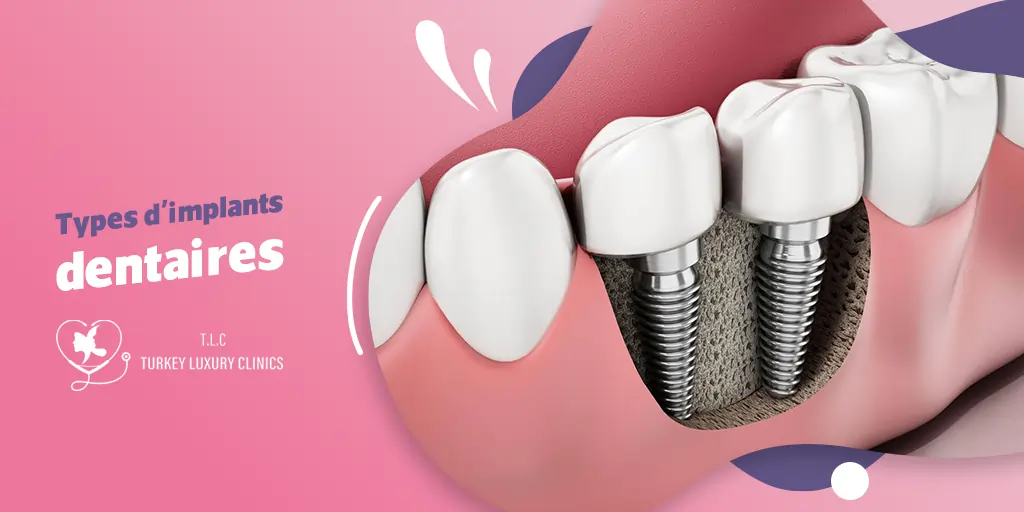 Types d'implants dentaires