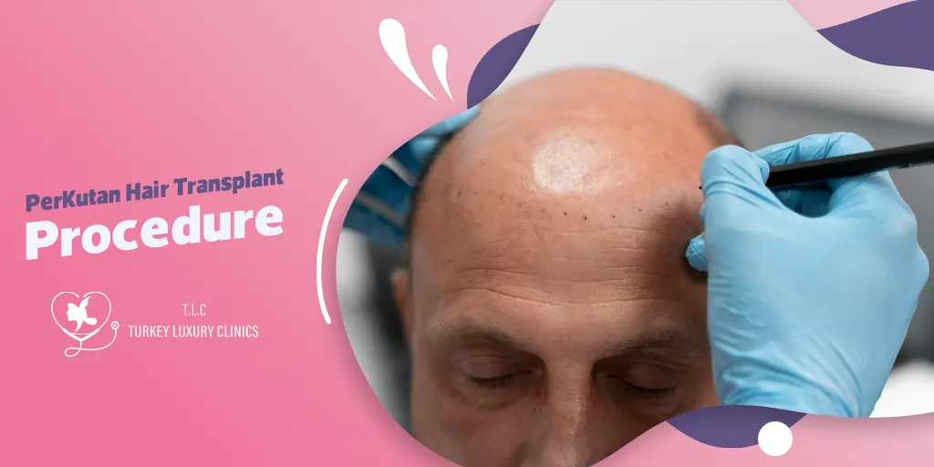 Perkutan Hair Transplant Procedure