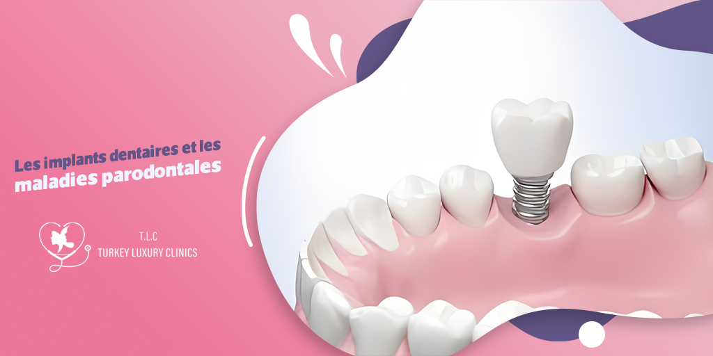 Les implants dentaires et les maladies parodontales