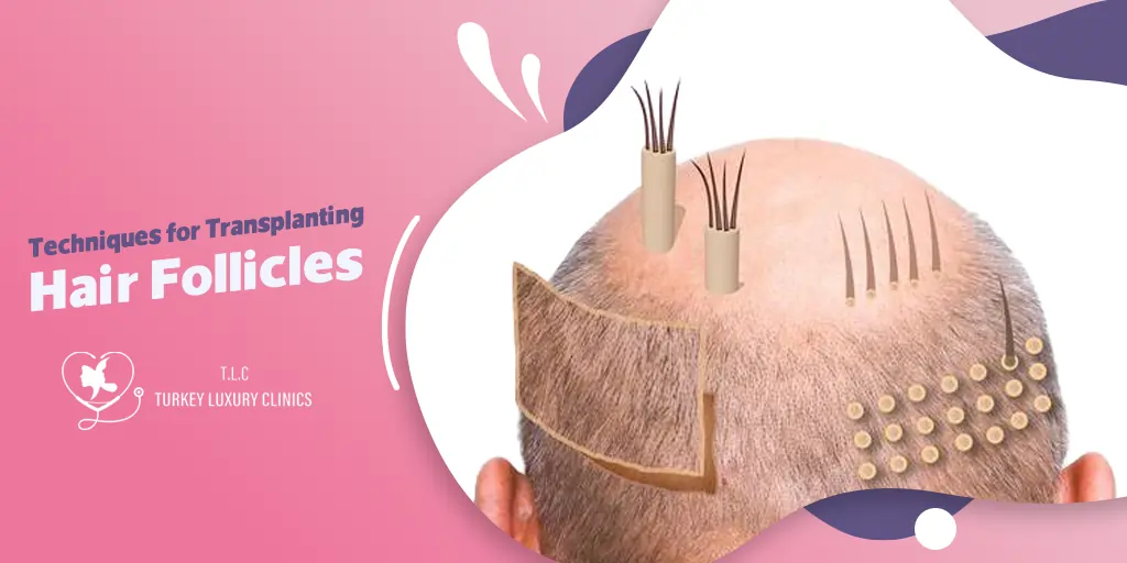 Techniques For Transplanting Hair Follicles