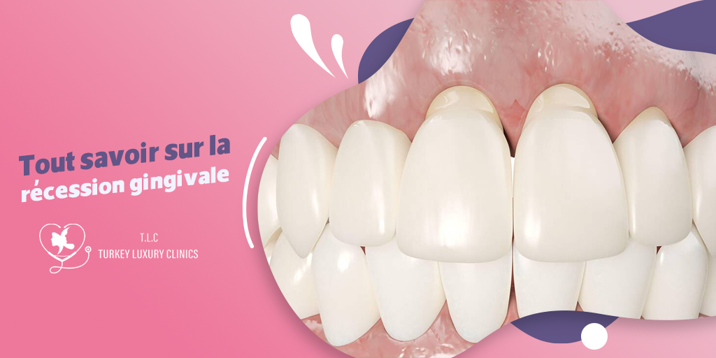 La récession gingivale – Causes, prévention et traitements