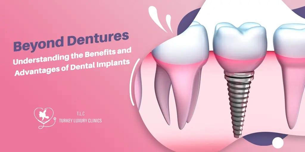 Beyond Dentures: Understanding the Benefits and Advantages of Dental Implants