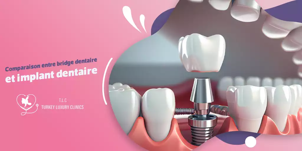 Comparaison entre bridge dentaire et implant dentaire