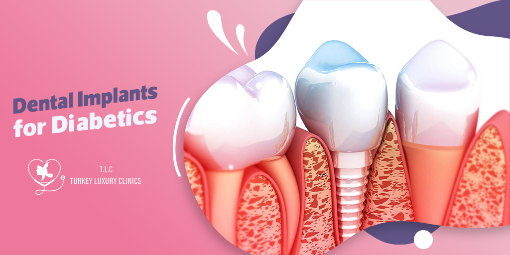 Dental Implants for Diabetics: Managing Risks for Successful Outcomes