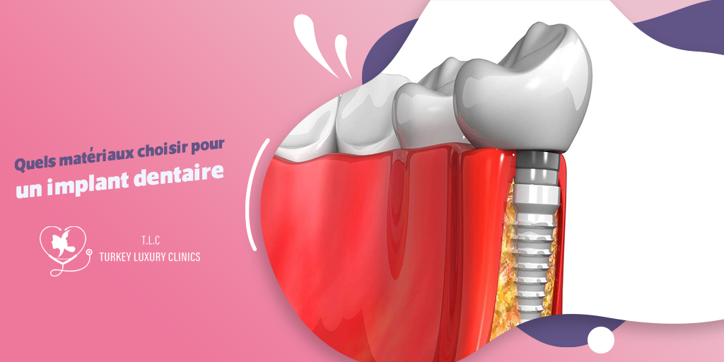 Quels matériaux choisir pour un implant dentaire