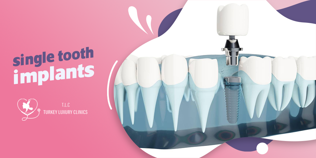 Single Tooth Implants: Restoring a Single Tooth Naturally and Permanently