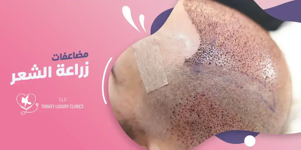 أهم مضاعفات عملية زراعة الشعر وكيفية تجنبها