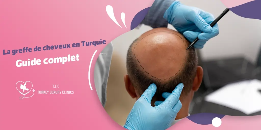 Greffe de cheveux en Turquie: Le guide complet