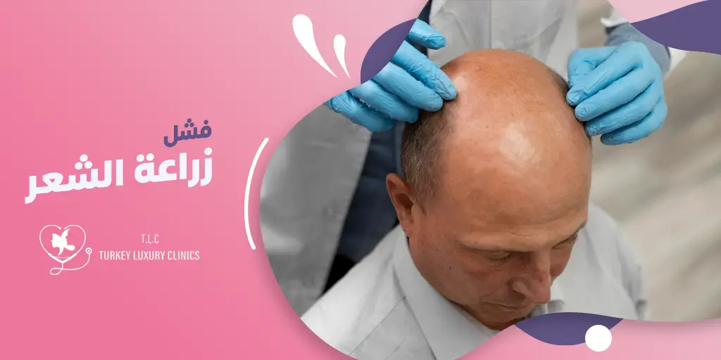 علامات فشل زراعة الشعر: أسباب الفشل وكيفية تجنبها