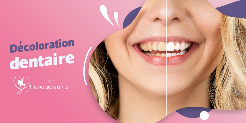 Décoloration dentaire – Causes et solutions pour des dents plus blanches