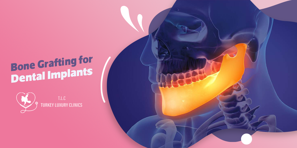 Bone Grafting for Dental Implants: Building a Strong Foundation for Success