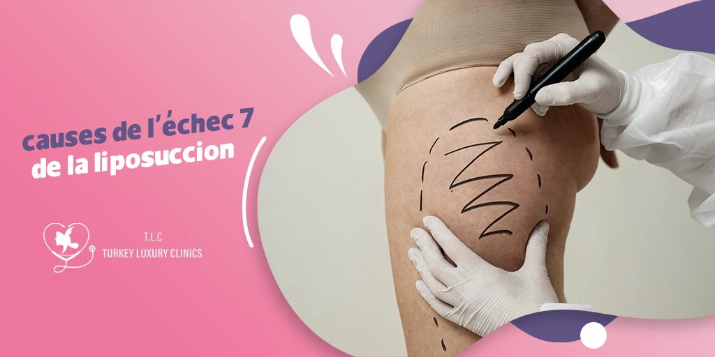 7 causes de l'échec de la liposuccion