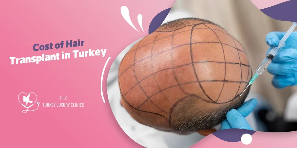 Cost of Hair Transplant in Turkey