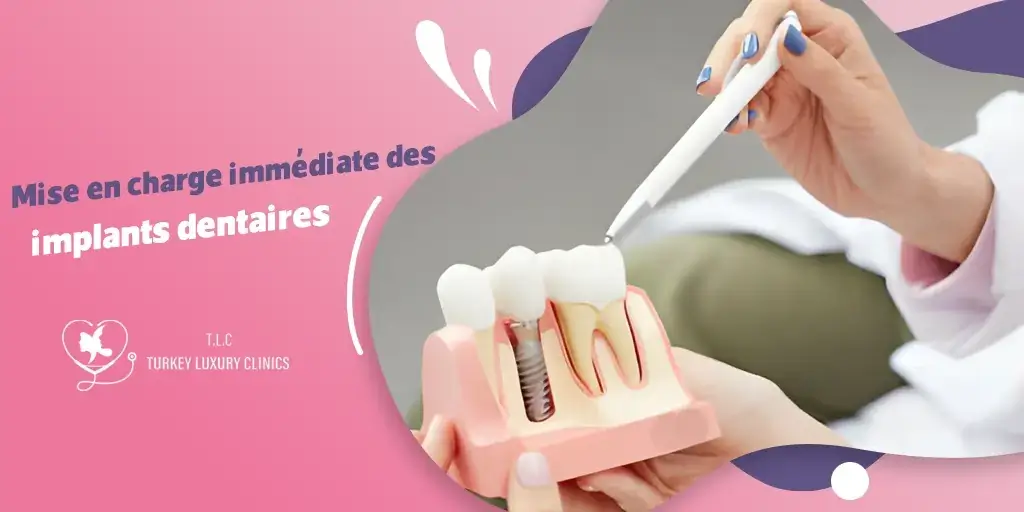 Mise en charge immédiate des implants dentaires