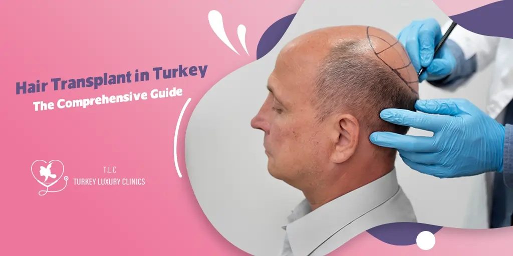 Hair Transplant in Turkey: The Comprehensive Guide