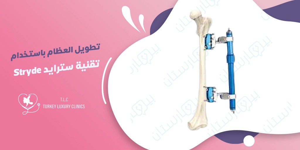 تطويل العظام باستخدام تقنية سترايد في تركيا