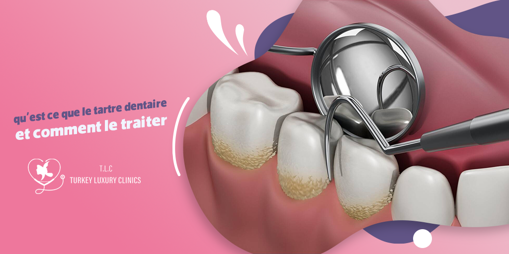 Qu'est ce que le tartre dentaire et comment le traiter ?