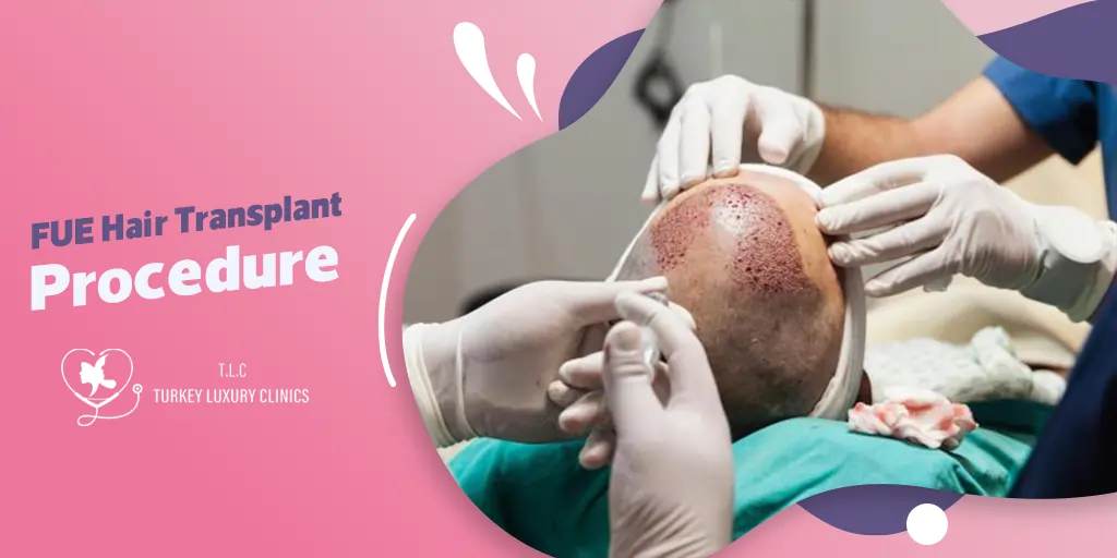 FUE Hair Transplant Procedure