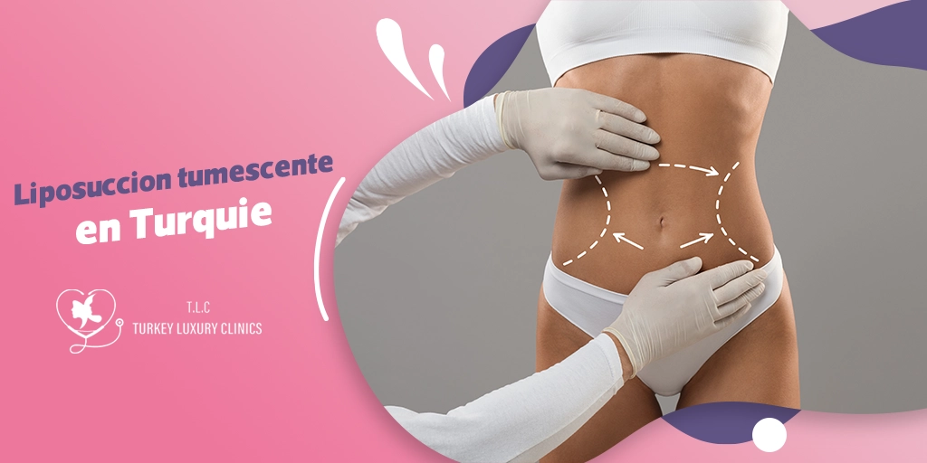 Liposuccion tumescente en Turquie